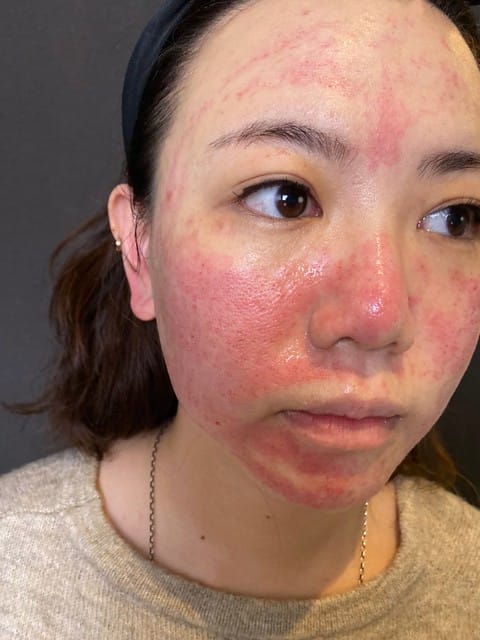 醫美。愛爾麗板橋店 告別瑕疵 探索皮秒雷射 快速養成水煮蛋肌好膚質 淨膚雷射 板橋愛爾麗 劉恭志醫師 醫美。愛爾麗板橋店 告別瑕疵 探索皮秒雷射 快速養成水煮蛋肌好膚質 淨膚雷射 板橋愛爾麗 劉恭志醫師