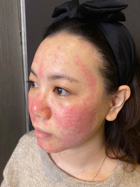 醫美。愛爾麗板橋店 告別瑕疵 探索皮秒雷射 快速養成水煮蛋肌好膚質 淨膚雷射 板橋愛爾麗 劉恭志醫師 醫美。愛爾麗板橋店 告別瑕疵 探索皮秒雷射 快速養成水煮蛋肌好膚質 淨膚雷射 板橋愛爾麗 劉恭志醫師