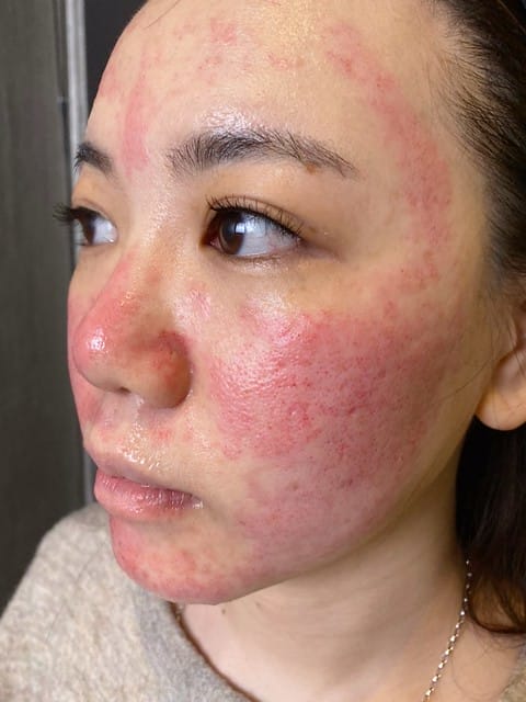 醫美。愛爾麗板橋店 告別瑕疵 探索皮秒雷射 快速養成水煮蛋肌好膚質 淨膚雷射 板橋愛爾麗 劉恭志醫師 醫美。愛爾麗板橋店 告別瑕疵 探索皮秒雷射 快速養成水煮蛋肌好膚質 淨膚雷射 板橋愛爾麗 劉恭志醫師