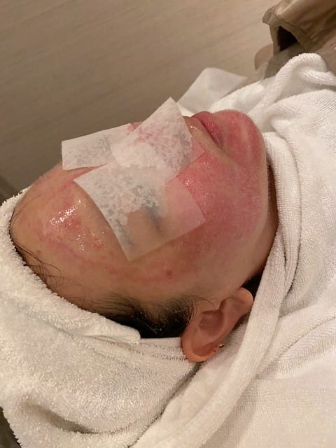 醫美。愛爾麗板橋店 告別瑕疵 探索皮秒雷射 快速養成水煮蛋肌好膚質 淨膚雷射 板橋愛爾麗 劉恭志醫師 醫美。愛爾麗板橋店 告別瑕疵 探索皮秒雷射 快速養成水煮蛋肌好膚質 淨膚雷射 板橋愛爾麗 劉恭志醫師