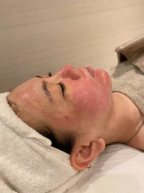 醫美。愛爾麗板橋店 告別瑕疵 探索皮秒雷射 快速養成水煮蛋肌好膚質 淨膚雷射 板橋愛爾麗 劉恭志醫師 醫美。愛爾麗板橋店 告別瑕疵 探索皮秒雷射 快速養成水煮蛋肌好膚質 淨膚雷射 板橋愛爾麗 劉恭志醫師