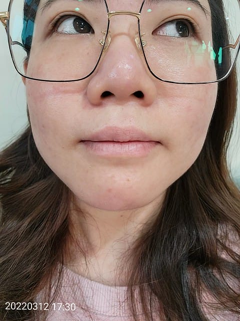 醫美。愛爾麗板橋店 告別瑕疵 探索皮秒雷射 快速養成水煮蛋肌好膚質 淨膚雷射 板橋愛爾麗 劉恭志醫師 醫美。愛爾麗板橋店 告別瑕疵 探索皮秒雷射 快速養成水煮蛋肌好膚質 淨膚雷射 板橋愛爾麗 劉恭志醫師