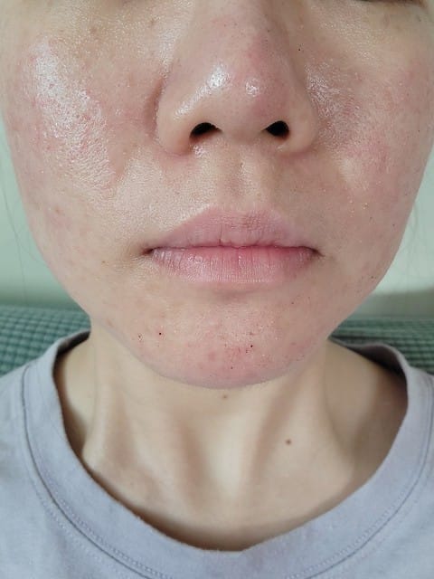 醫美。愛爾麗板橋店 告別瑕疵 探索皮秒雷射 快速養成水煮蛋肌好膚質 淨膚雷射 板橋愛爾麗 劉恭志醫師 醫美。愛爾麗板橋店 告別瑕疵 探索皮秒雷射 快速養成水煮蛋肌好膚質 淨膚雷射 板橋愛爾麗 劉恭志醫師