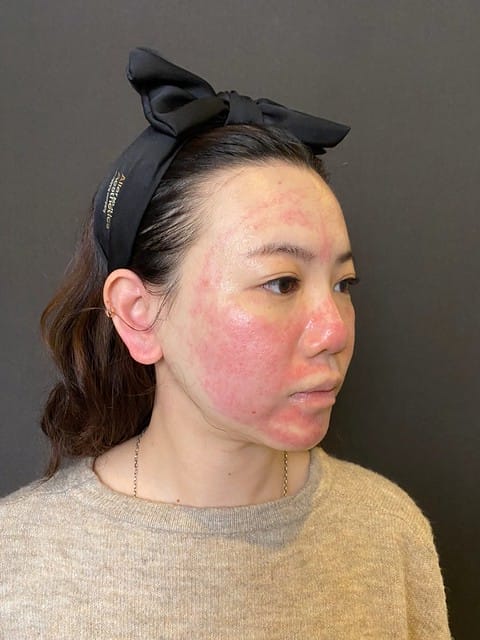 醫美。愛爾麗板橋店 告別瑕疵 探索皮秒雷射 快速養成水煮蛋肌好膚質 淨膚雷射 板橋愛爾麗 劉恭志醫師 醫美。愛爾麗板橋店 告別瑕疵 探索皮秒雷射 快速養成水煮蛋肌好膚質 淨膚雷射 板橋愛爾麗 劉恭志醫師