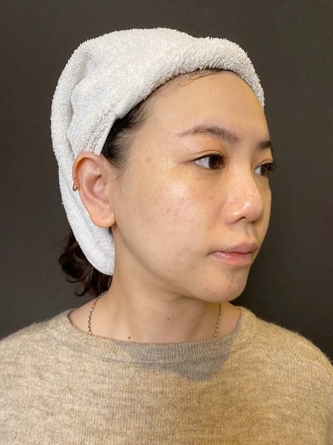 醫美。愛爾麗板橋店 告別瑕疵 探索皮秒雷射 快速養成水煮蛋肌好膚質 淨膚雷射 板橋愛爾麗 劉恭志醫師 醫美。愛爾麗板橋店 告別瑕疵 探索皮秒雷射 快速養成水煮蛋肌好膚質 淨膚雷射 板橋愛爾麗 劉恭志醫師