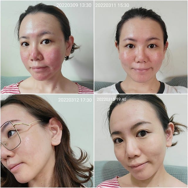 醫美。愛爾麗板橋店 告別瑕疵 探索皮秒雷射 快速養成水煮蛋肌好膚質 淨膚雷射 板橋愛爾麗 劉恭志醫師 醫美。愛爾麗板橋店 告別瑕疵 探索皮秒雷射 快速養成水煮蛋肌好膚質 淨膚雷射 板橋愛爾麗 劉恭志醫師