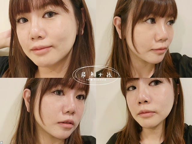 名悅時尚診所 Dcard,名悅時尚診所評價,名悅時尚診所 價格,名 悅 皮秒,名悅時尚診所,皮秒雷射術後保養品推薦,皮秒雙機亮白雷射,皮秒結痂ptt,皮秒雷射心得,皮秒止癢,皮秒術後保養品推薦,皮秒雷射推薦台北,皮秒推薦,皮秒蜂巢,皮秒蜂巢術後癢,皮秒蜂巢術後保養品推薦,皮秒蜂巢多久打一次,皮秒蜂巢毛孔dcard,蜂巢皮秒毛孔ptt,皮秒蜂巢 恢復期 PTT,皮秒雷射效果,名悅時尚,皮秒雙機雷射推薦,打擊痘疤曬斑,皮秒雷射後遺症,皮秒雷射療程步驟,如何改善肌膚瑕疵,混和肌瑕疵修復,皮秒雷射真實記錄 名悅時尚診所 Dcard,名悅時尚診所評價,名悅時尚診所 價格,名 悅 皮秒,名悅時尚診所,皮秒雷射術後保養品推薦,皮秒雙機亮白雷射,皮秒結痂ptt,皮秒雷射心得,皮秒止癢,皮秒術後保養品推薦,皮秒雷射推薦台北,皮秒推薦,皮秒蜂巢,皮秒蜂巢術後癢,皮秒蜂巢術後保養品推薦,皮秒蜂巢多久打一次,皮秒蜂巢毛孔dcard,蜂巢皮秒毛孔ptt,皮秒蜂巢 恢復期 PTT,皮秒雷射效果,名悅時尚,皮秒雙機雷射推薦,打擊痘疤曬斑,皮秒雷射後遺症,皮秒雷射療程步驟,如何改善肌膚瑕疵,混和肌瑕疵修復,皮秒雷射真實記錄